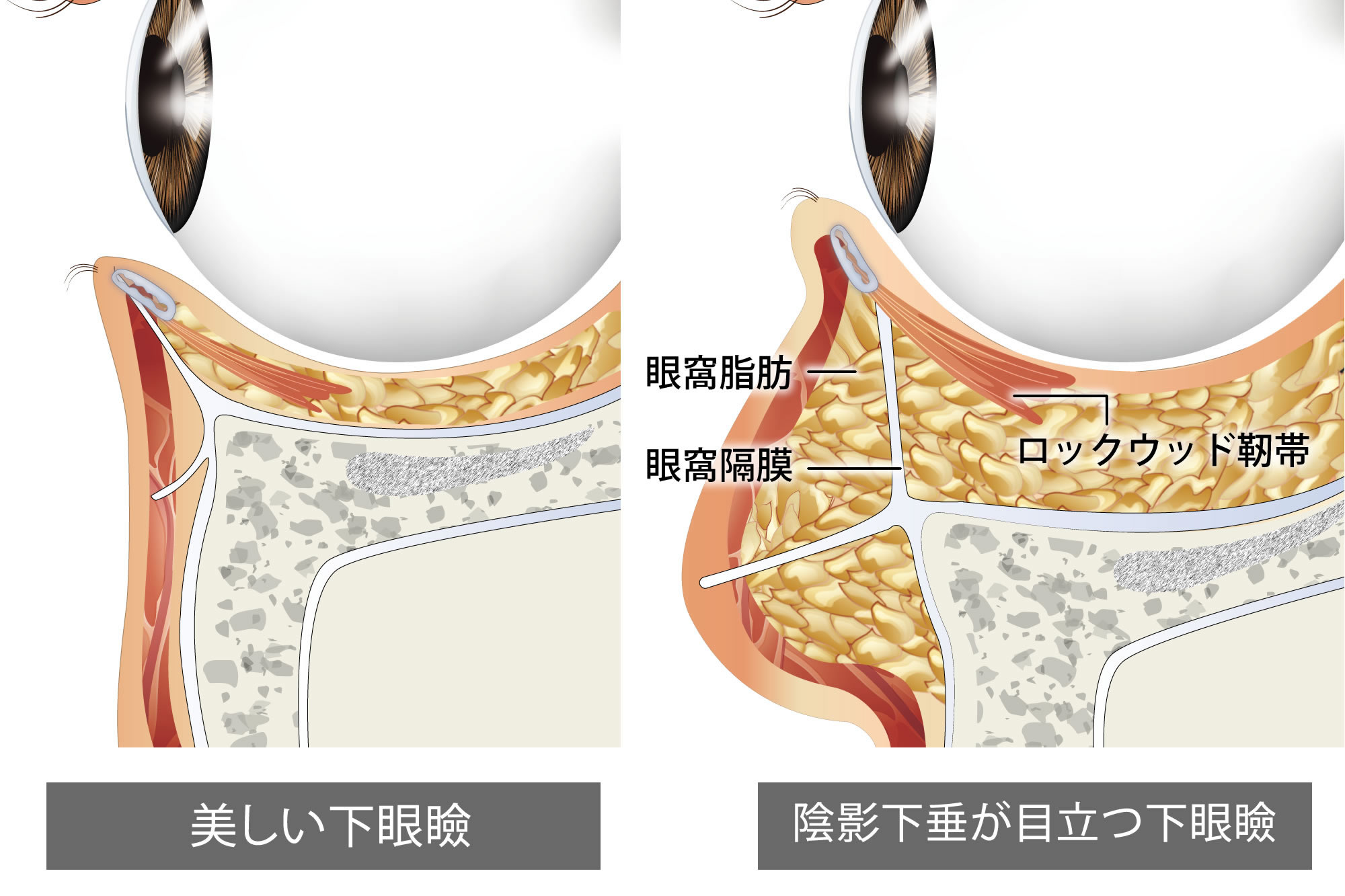 札幌院の目の下のクマの図解