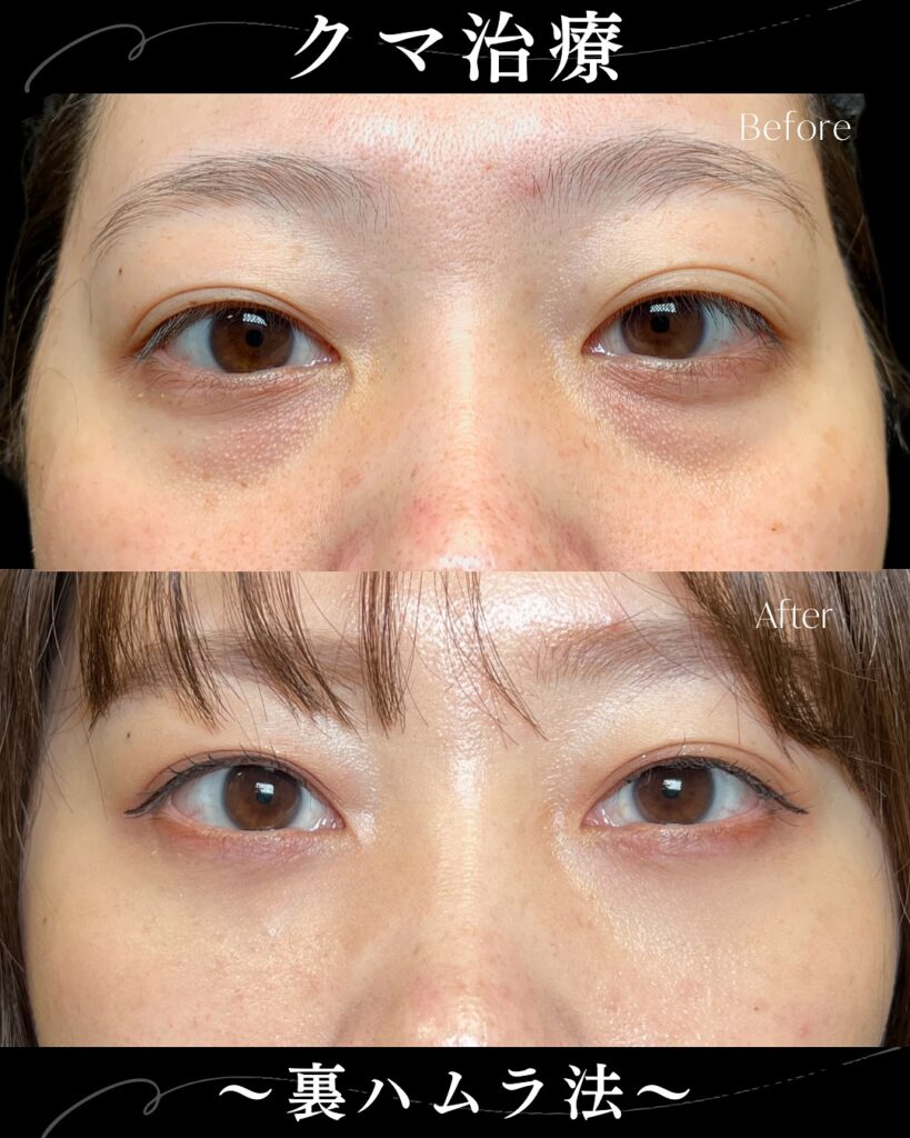 裏ハムラ法の症例写真 (38)