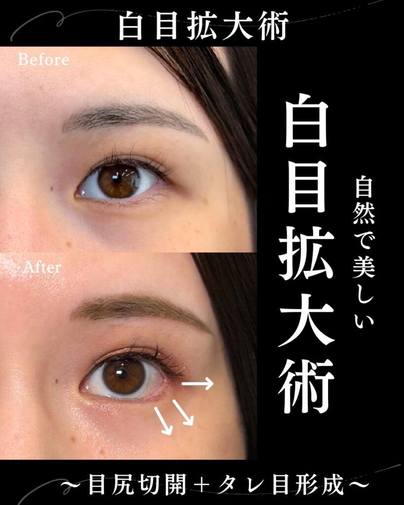 目尻切開とタレ目形成の症例写真