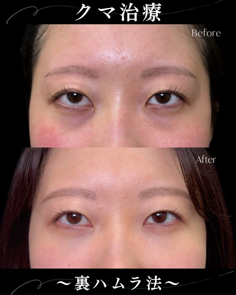 裏ハムラ法の症例写真 (39)