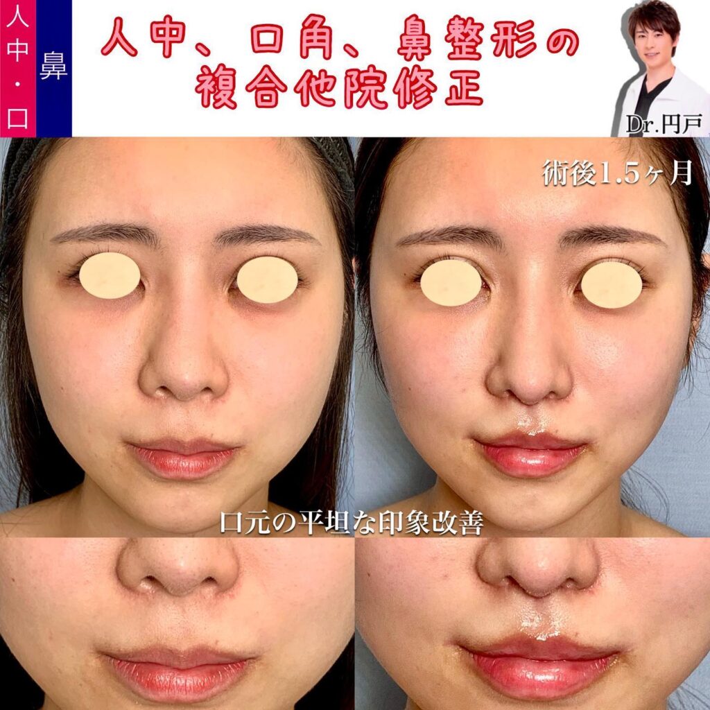 口角挙上と人中短縮と外側人中短縮の傷痕修正と鼻中隔延長の他院修正の症例写真