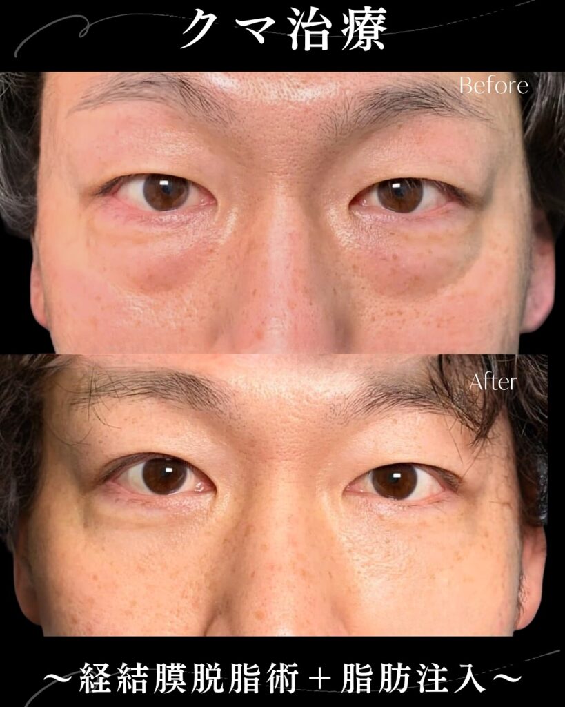 脱脂と脂肪注入の症例写真 (1)