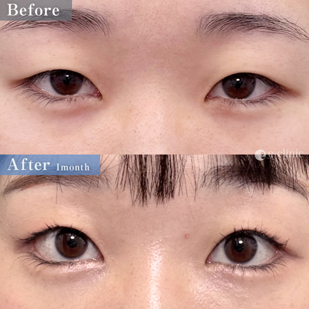 タレ目形成（結膜法）＋目尻切開（八木良太）（80）