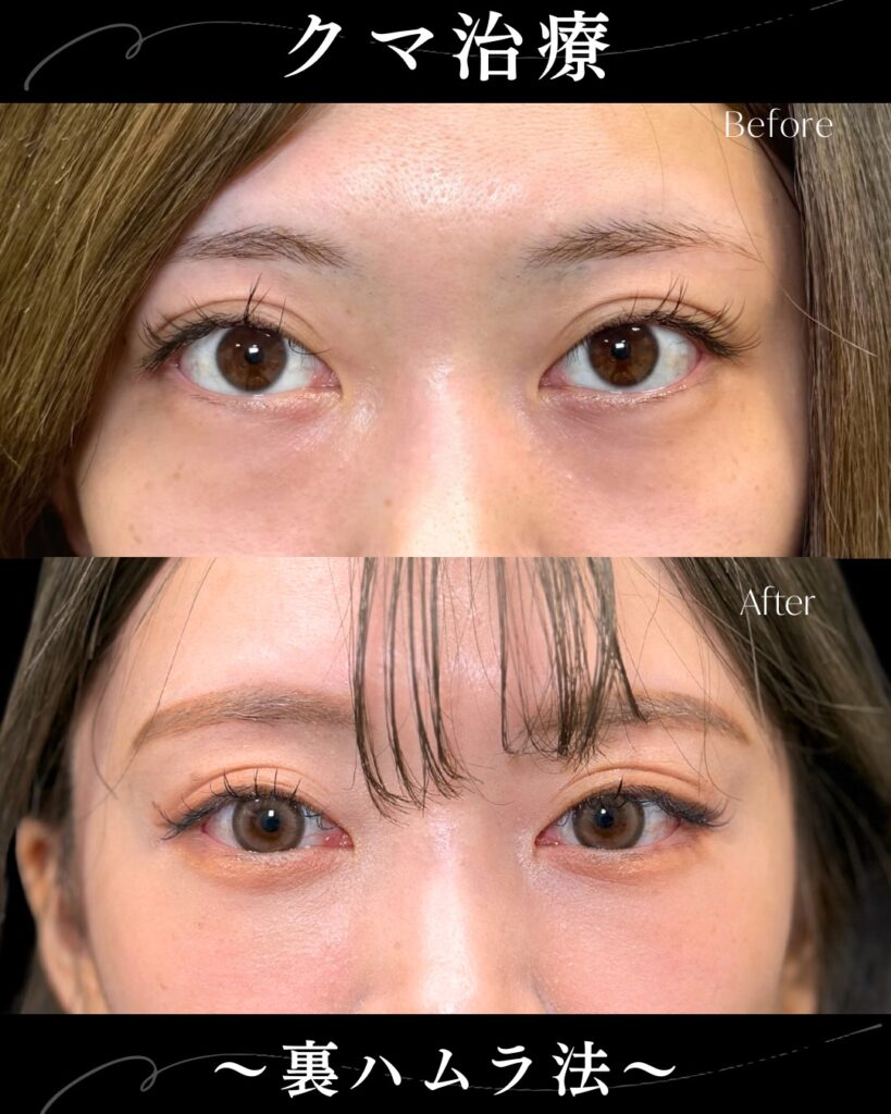 裏ハムラ法の症例写真 (33)