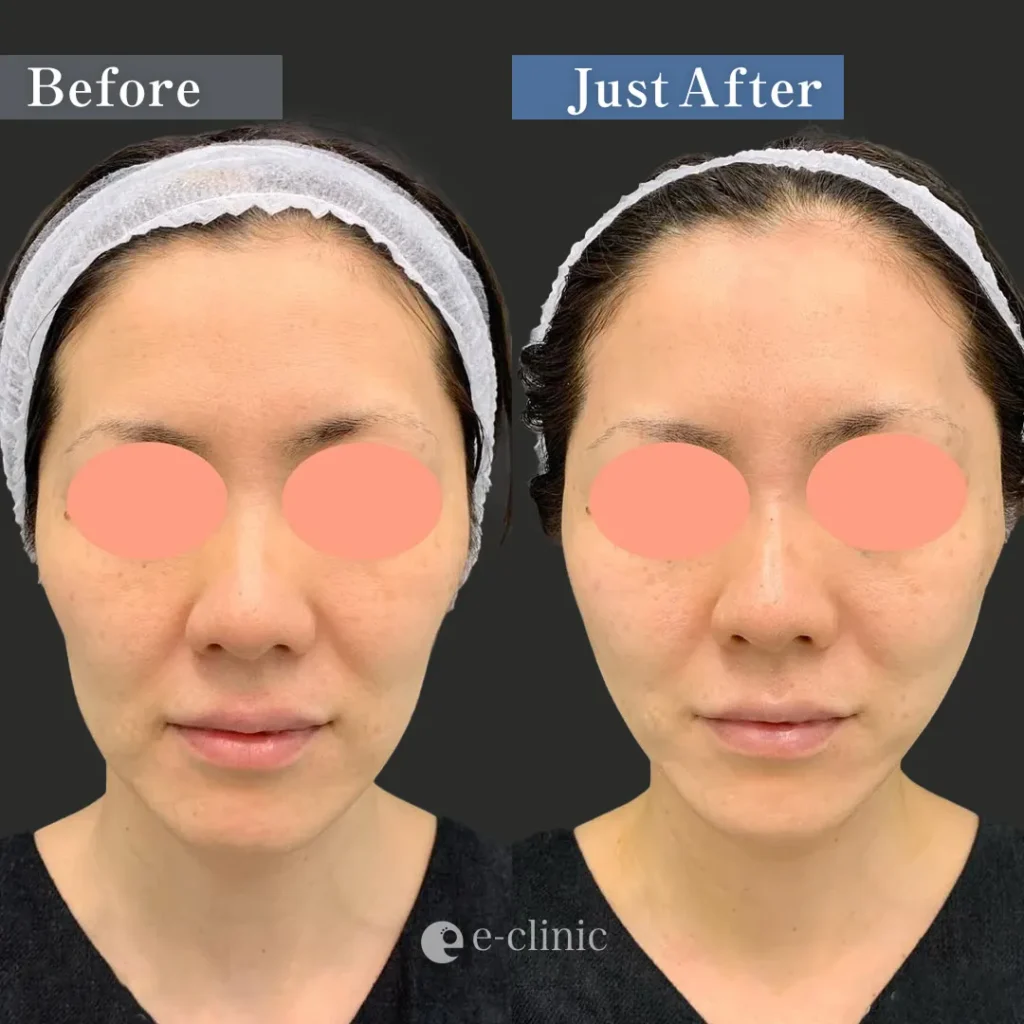 ハイブリッドフェイスリフト（張田修平）（26）