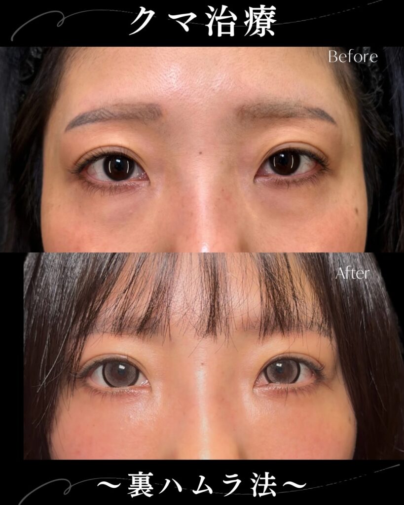 裏ハムラ法の症例写真 (36)