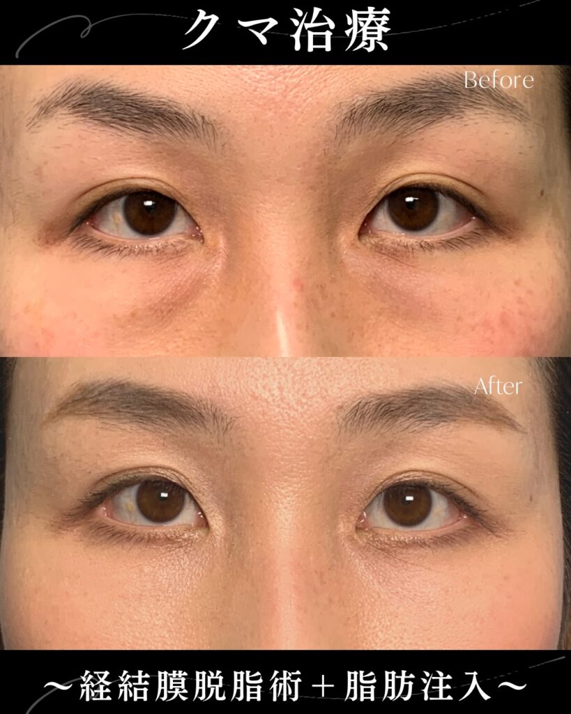 脱脂と脂肪注入の症例写真 (7)