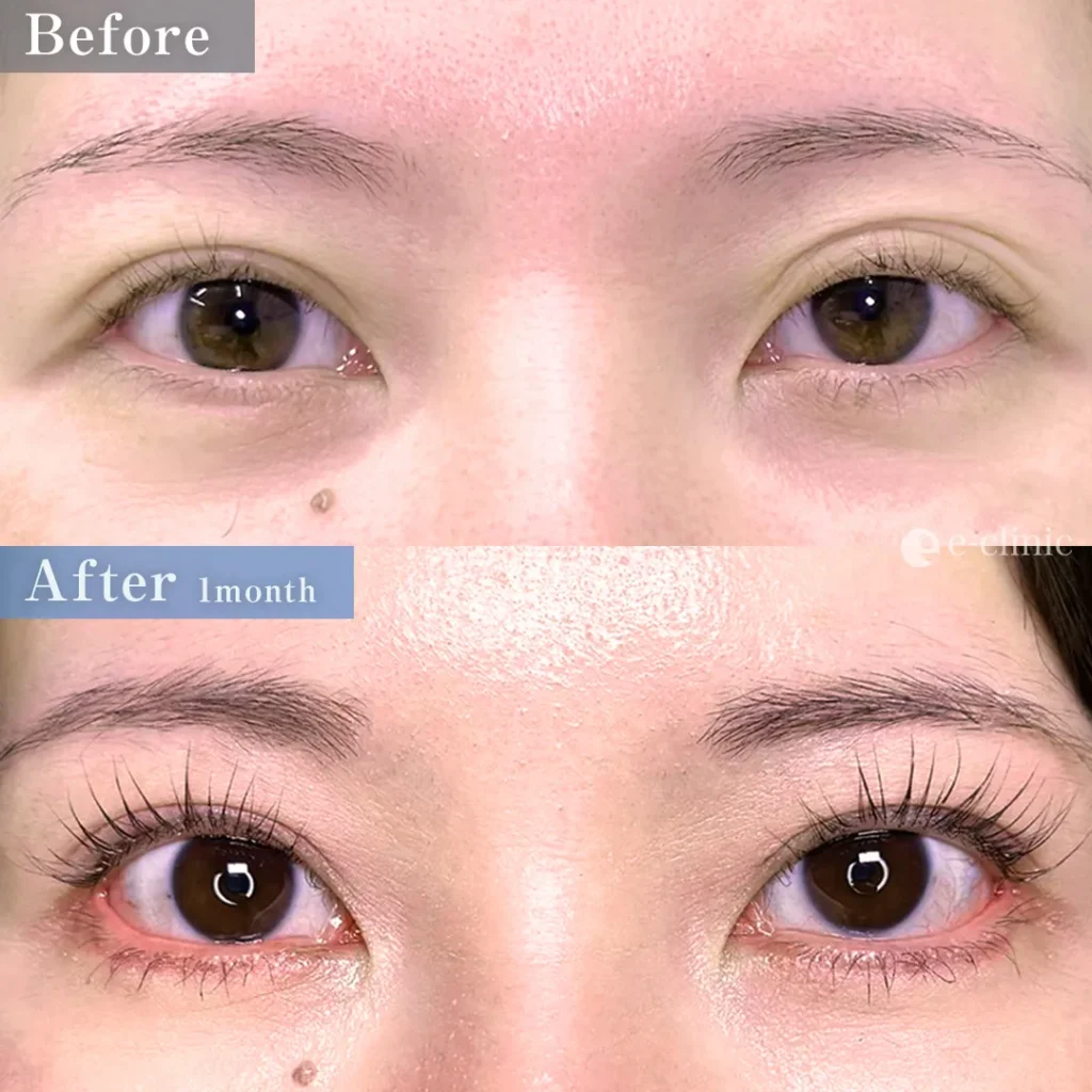 目尻切開＋タレ目形成（皮膚＋結膜）（坂本優衣）（28）