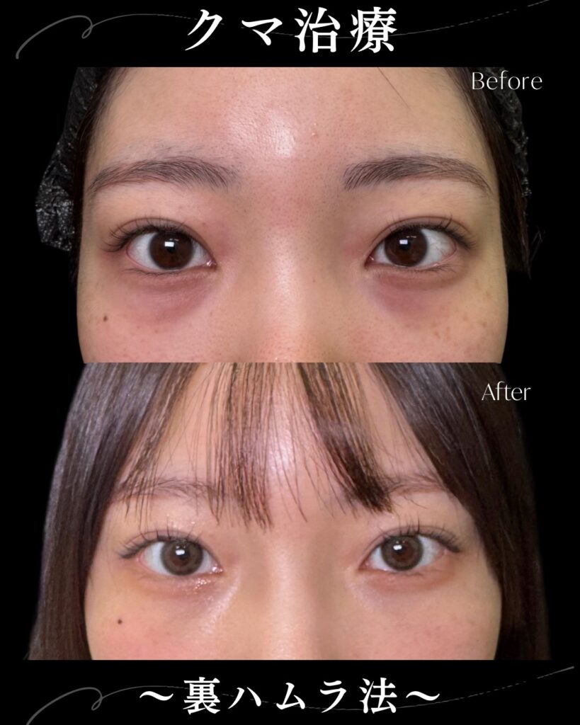 裏ハムラ法の症例写真 (41)