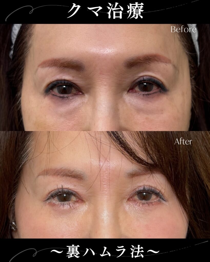 裏ハムラ法の症例写真 (40)