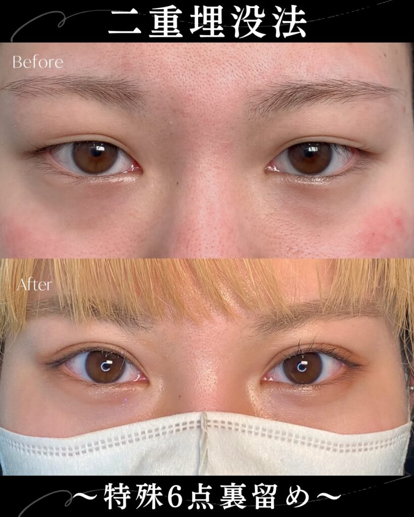 埋没法の症例写真 (21)