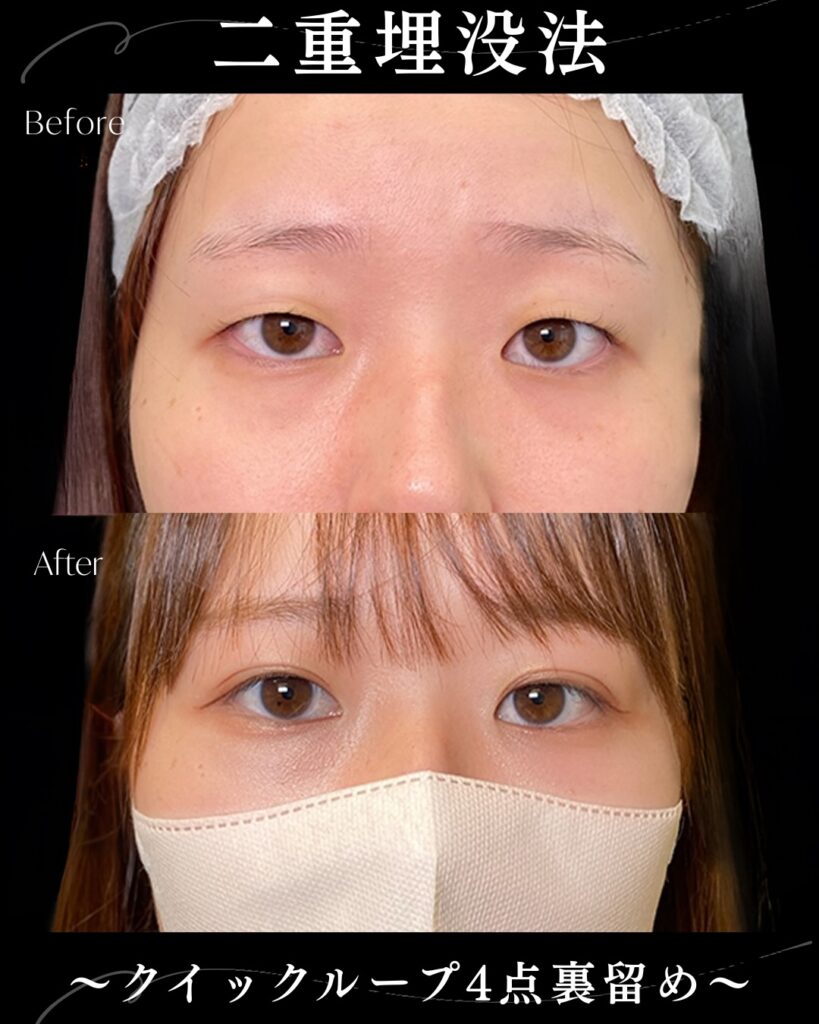 埋没法の症例写真 (23)