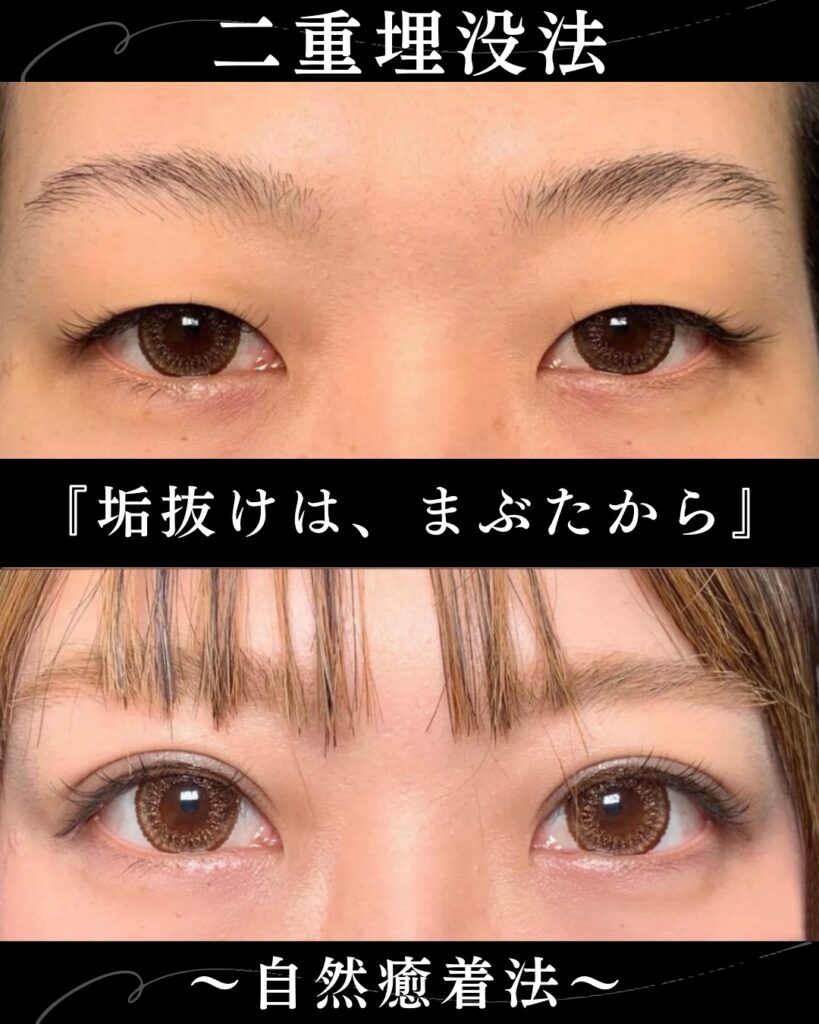 自然癒着法の症例写真 (11)