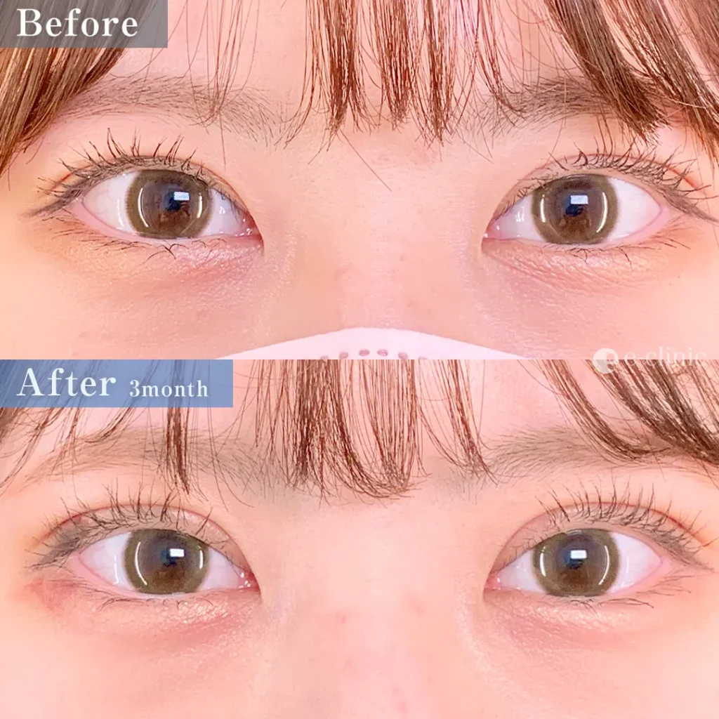 たるみ取り併用全切開二重術＋軽度眼瞼下垂（名医の張田修平医師が執刀）（22）