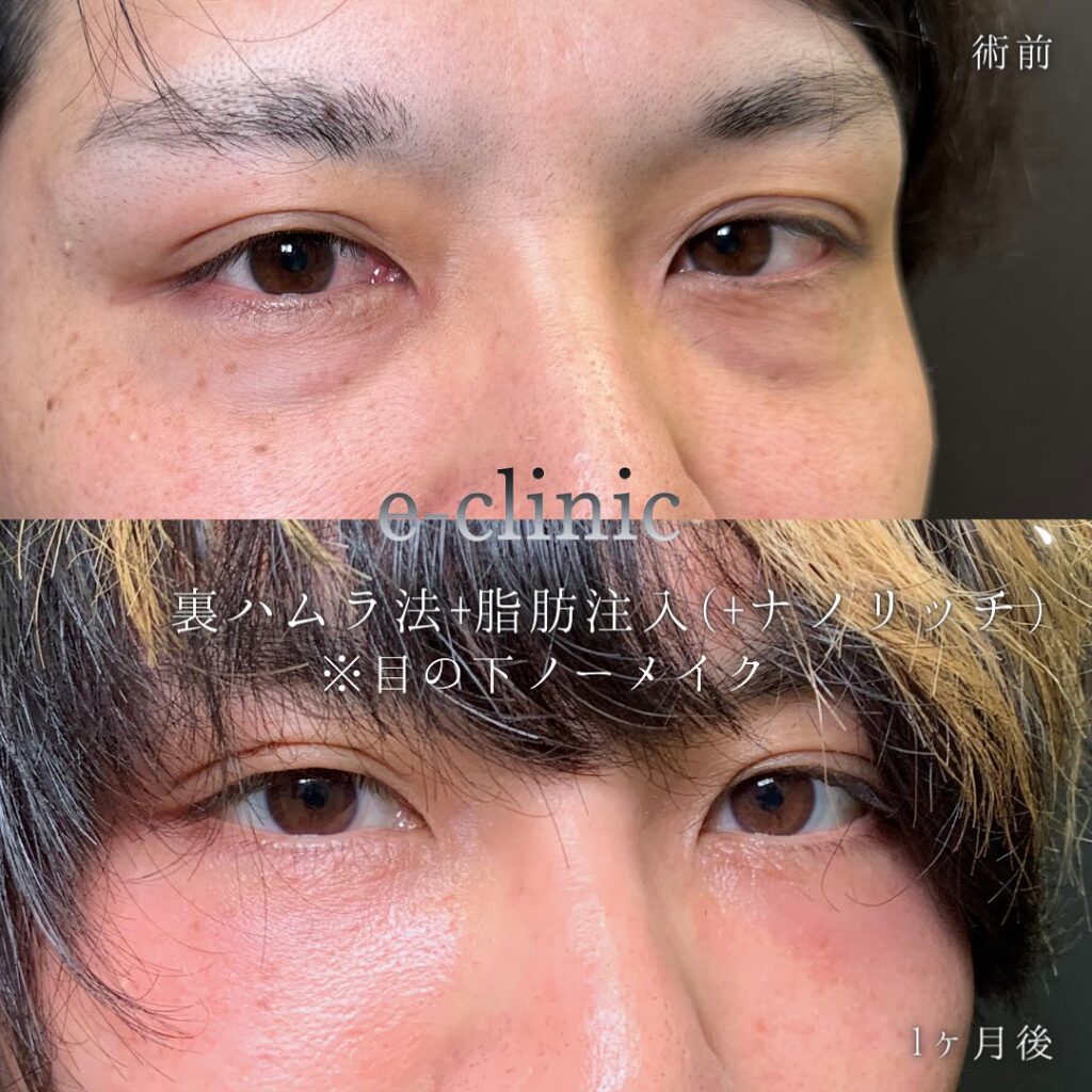 裏ハムラ法と脂肪注入をした福岡の30代の男性の症例