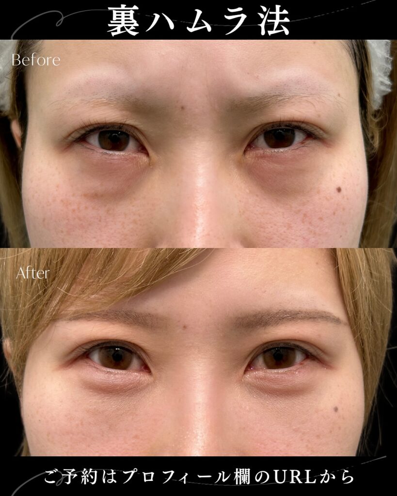 裏ハムラ法の症例写真 (32)