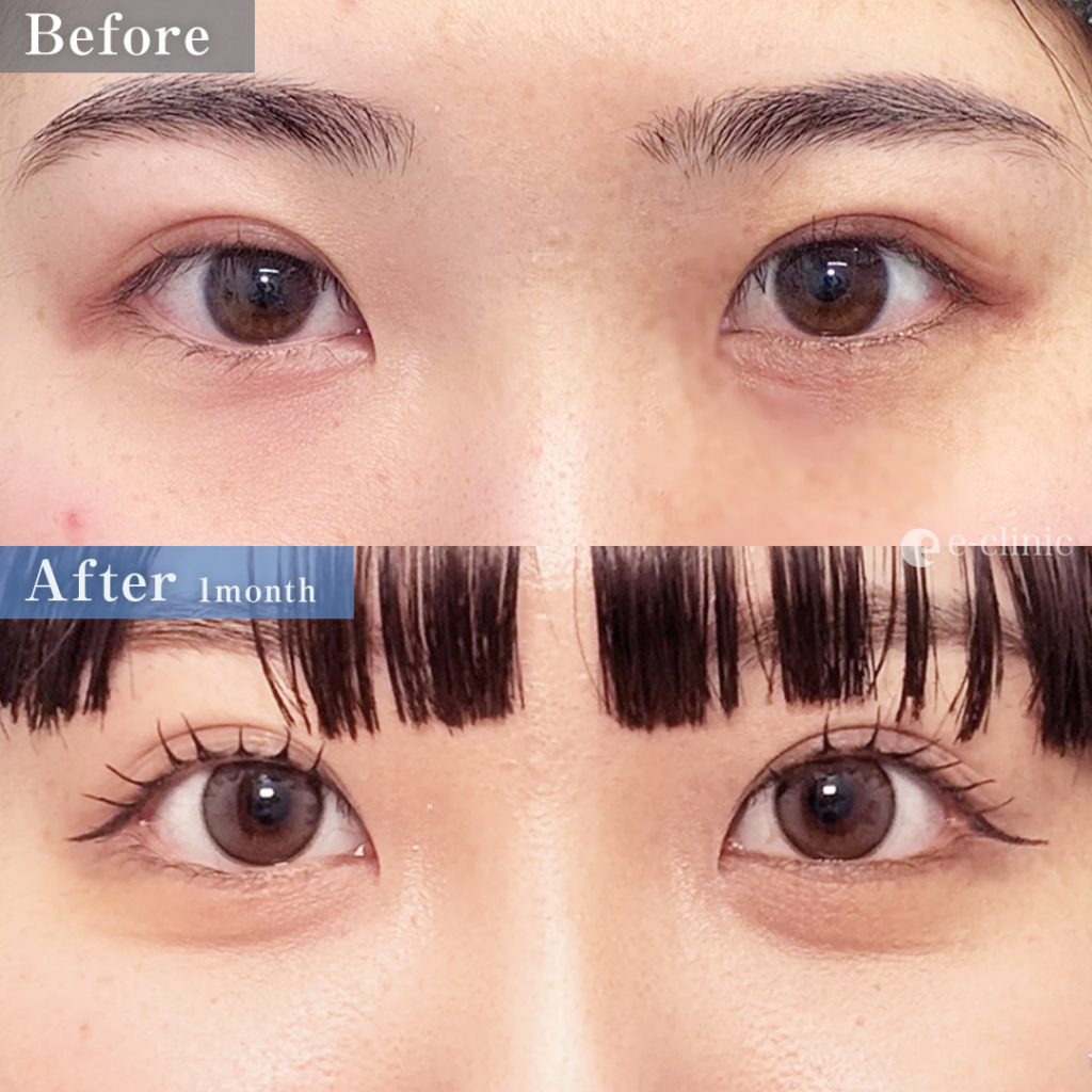 タレ目形成（結膜法）＋目尻切開＋クマ取り_経結膜脱脂（八木良太）（78）