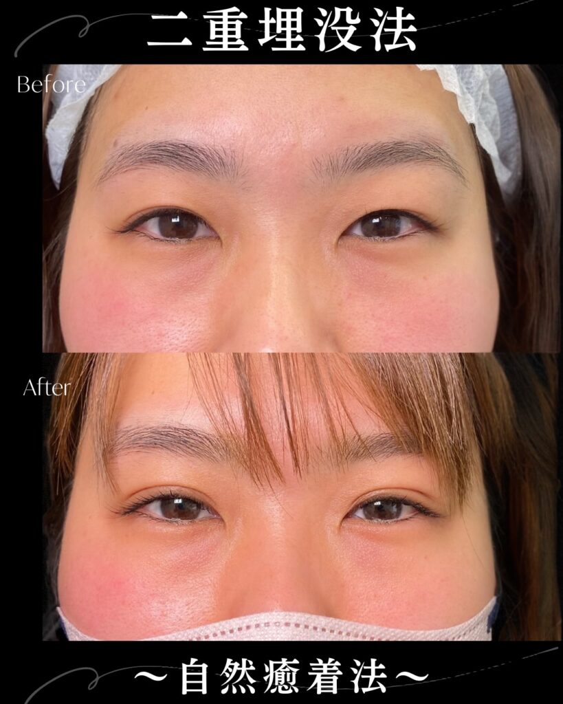 自然癒着法の症例写真 (12)