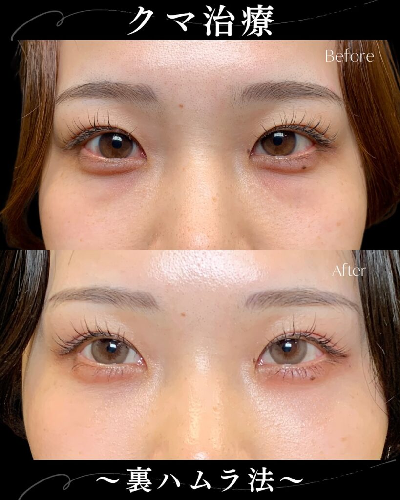 裏ハムラ法の症例写真 (29)