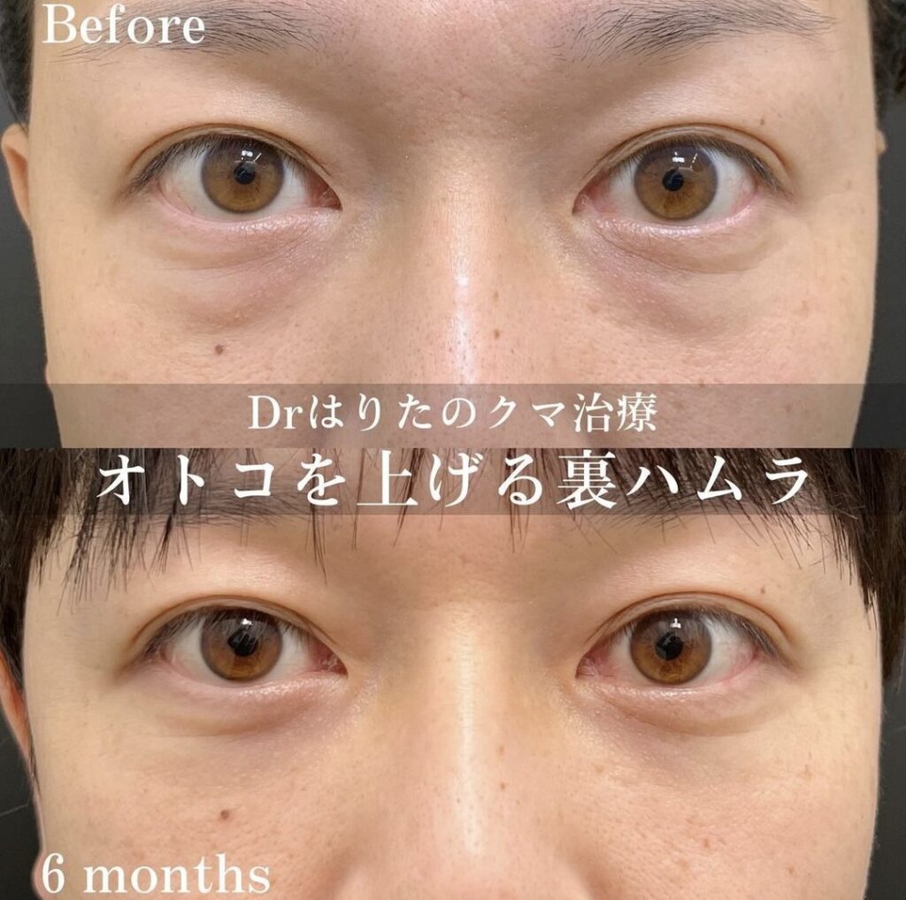 男性の裏ハムラ法の症例