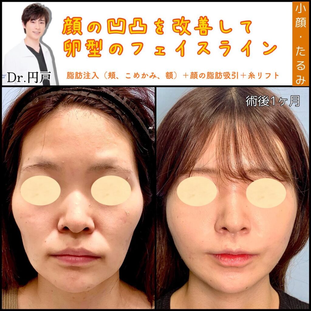 顔の脂肪注入、顔の脂肪吸引、糸リフト、貴族手術を併用した１か月後の症例写真