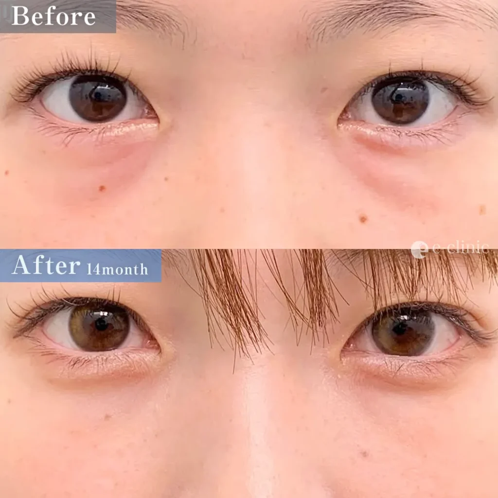 クマ取り_裏ハムラ（名医の張田修平医師が執刀）（17）