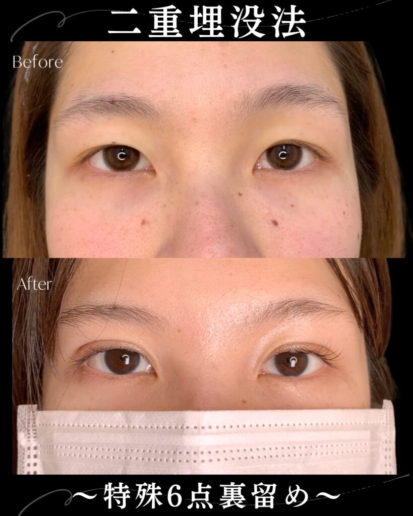 埋没法の症例写真 (20)