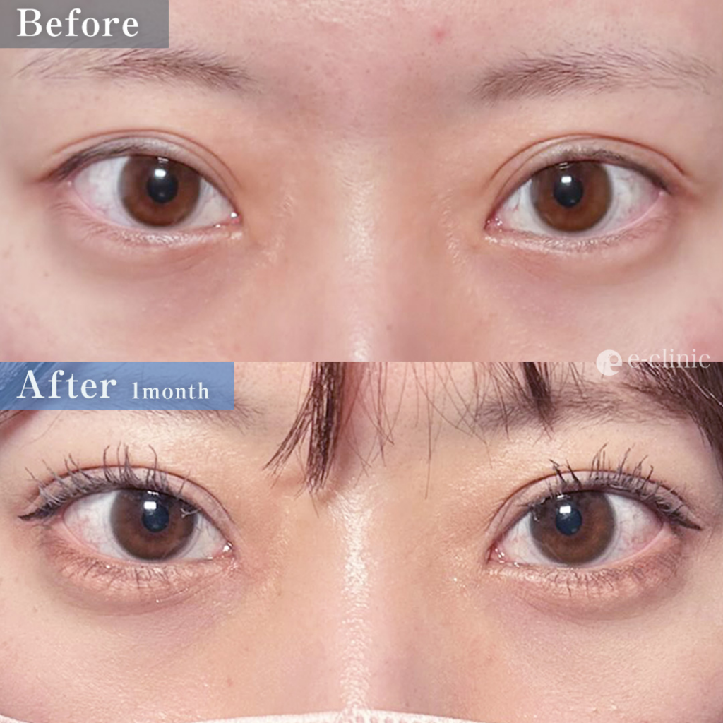 二重整形_埋没法 自然癒着法（他院修正：埋没裏留め抜糸）　（伊藤渉）（67）