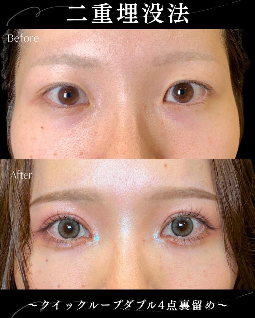 埋没法の症例写真 (18)