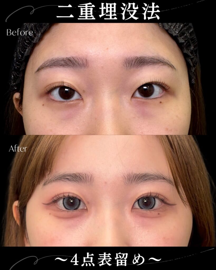 埋没法の症例写真 (17)