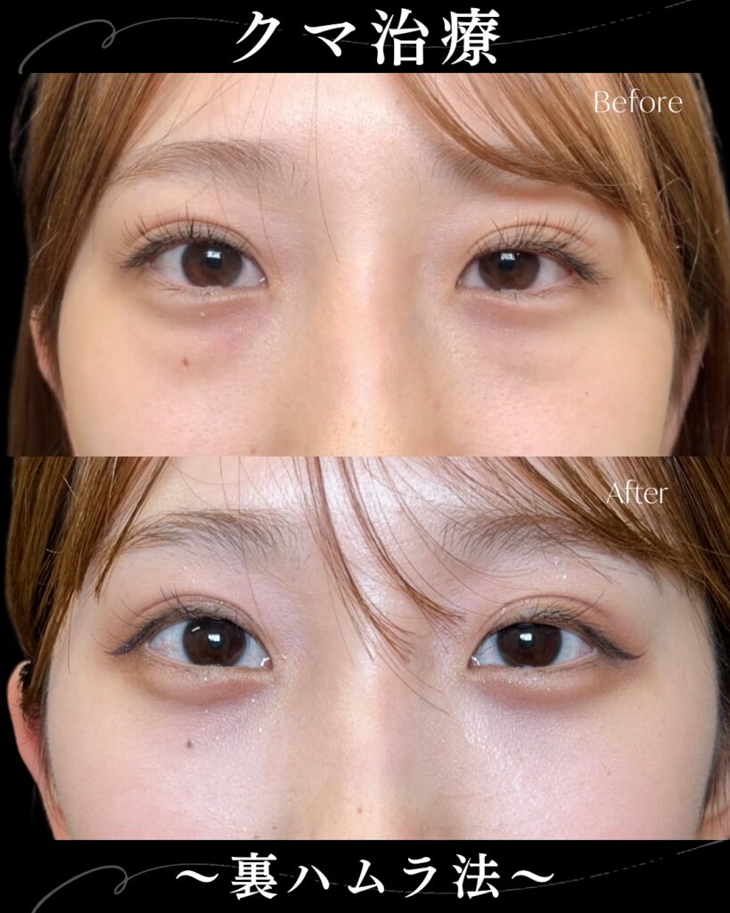 裏ハムラ法の症例写真 (35)