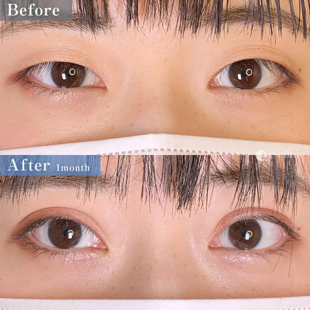 二重埋没_特殊6点留め（名医の張田修平医師が執刀）（23）