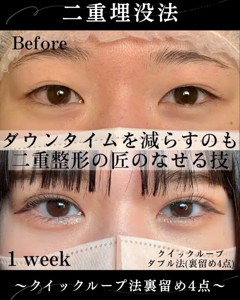 埋没法の症例写真 (22)