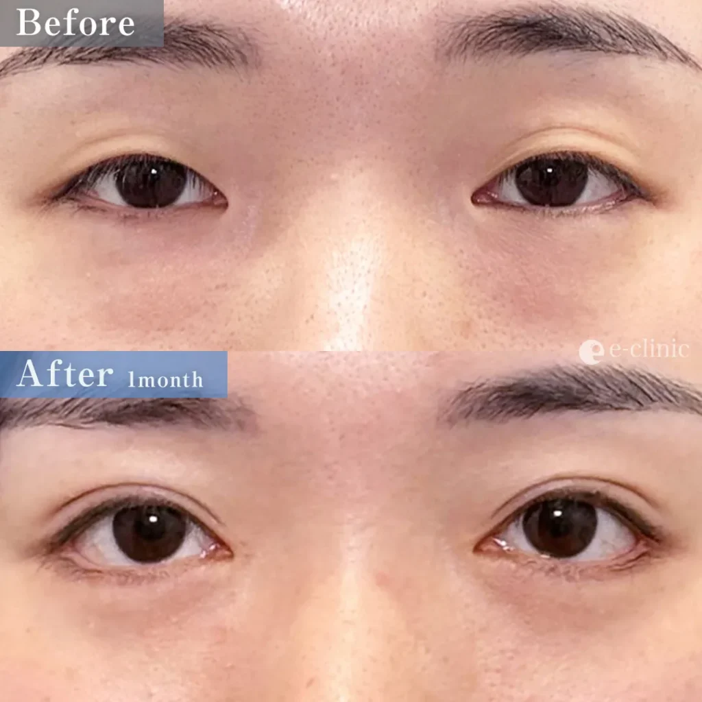 二重埋没法_自然癒着法+目頭切開+たれ目形成(皮膚結膜法)+目尻切開+クマ取り裏ハムラ(82)