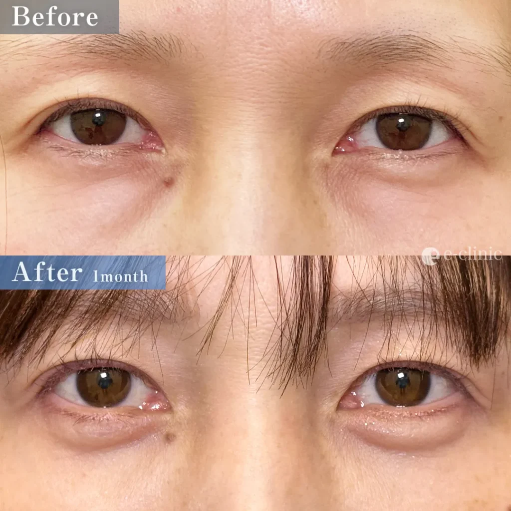 経結膜脱脂＋目の下脂肪注入（コンデンス＋ナノリッチ）＋涙袋ヒアルロン酸（名医の坂本優衣医師が執刀）（29）