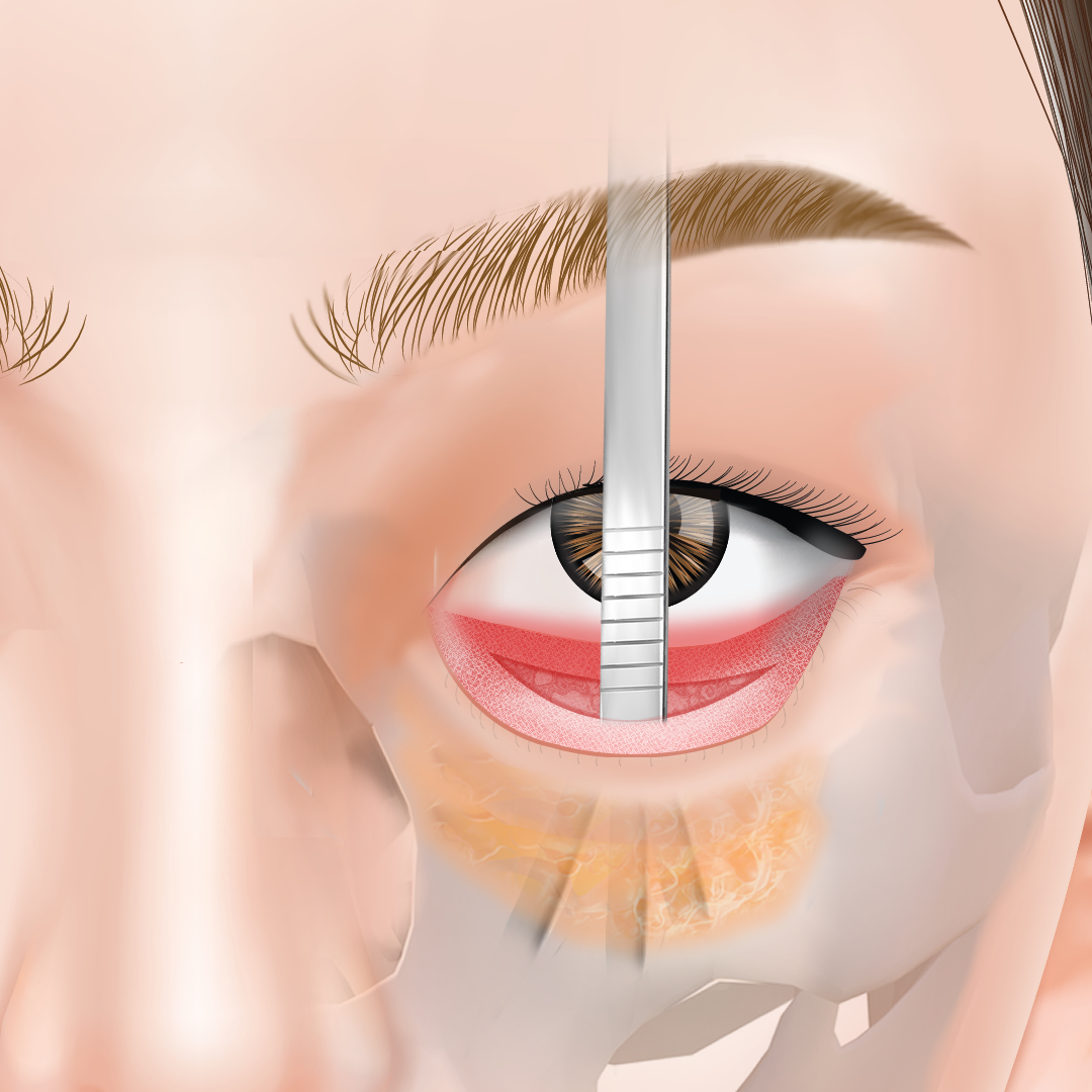 裏ハムラで骨と眼窩脂肪を剥離している図解