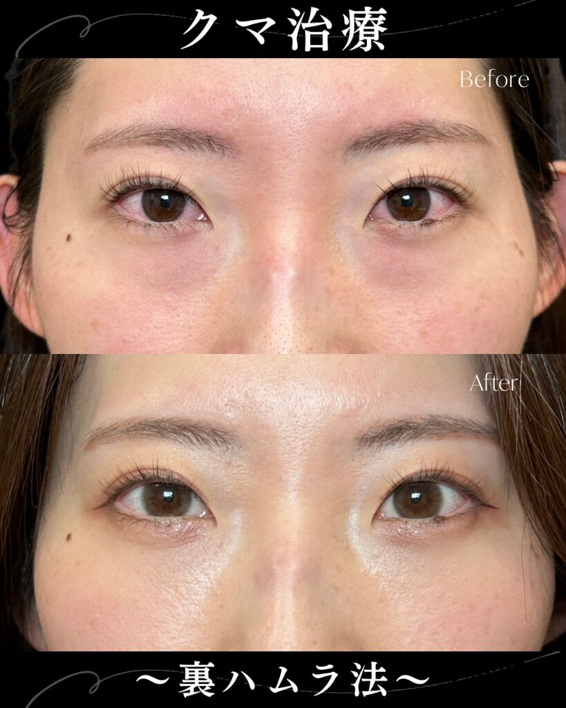 裏ハムラ法の症例写真 (30)