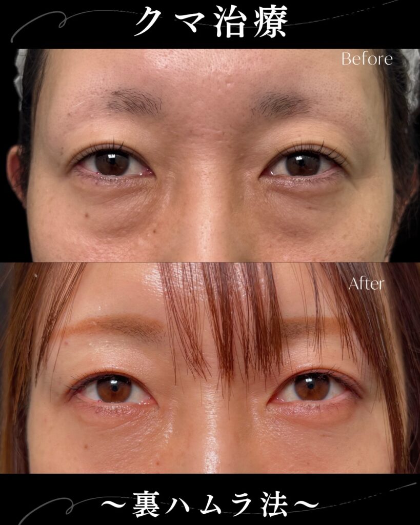 裏ハムラ法の症例写真 (34)