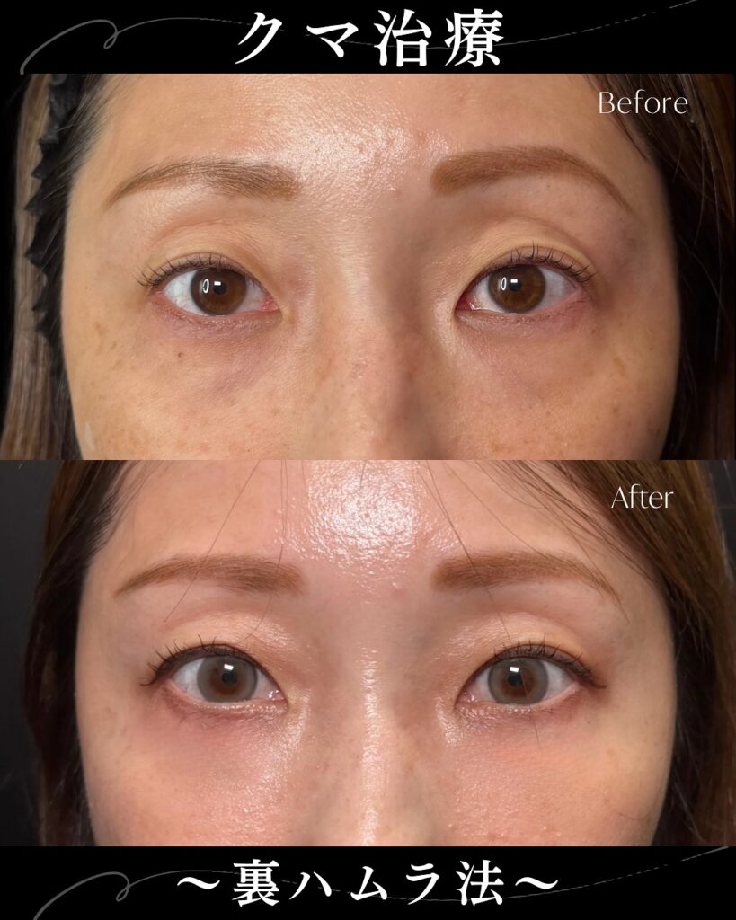 裏ハムラ法の症例写真 (28)