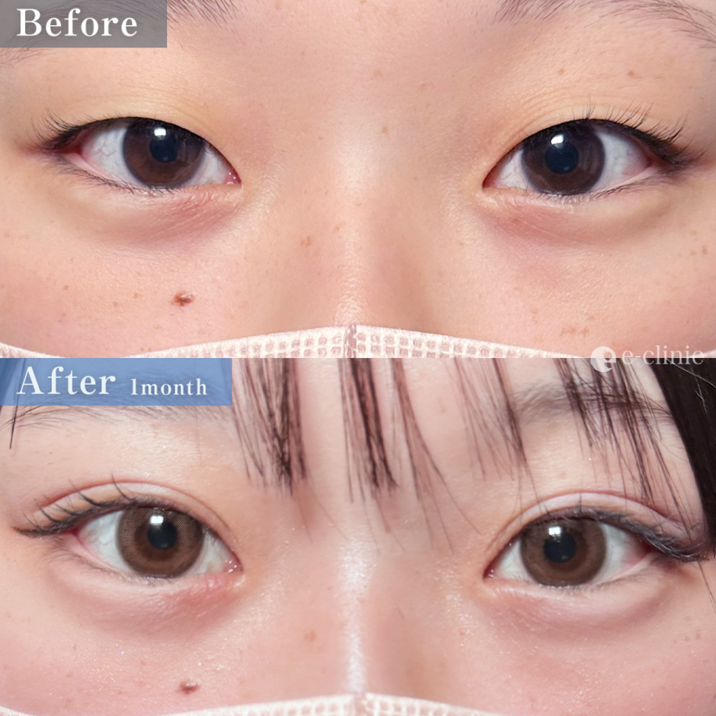 二重整形_埋没法 自然癒着法（伊藤渉）（68）