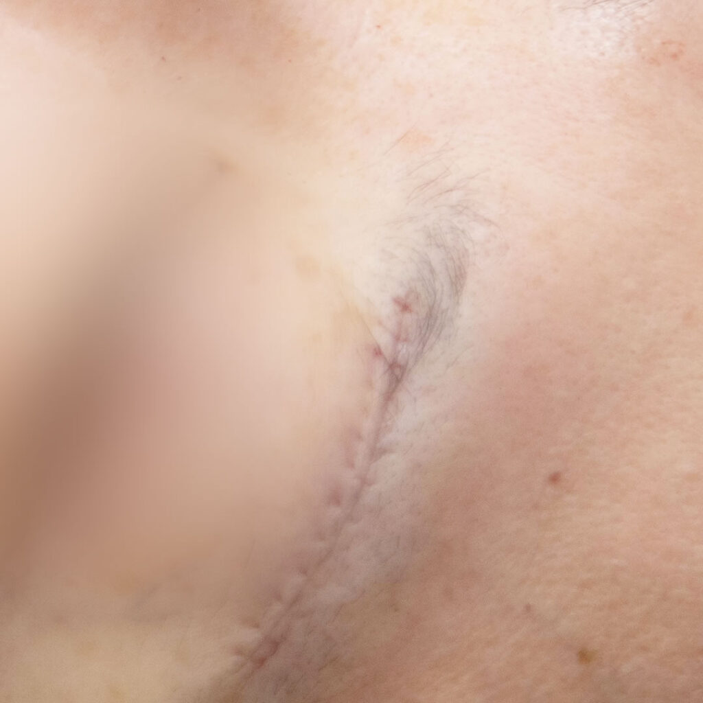 eクリニックの眉下切開の術直後の傷跡