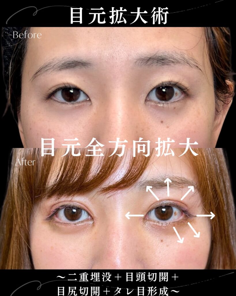 埋没法と目頭切開とタレ目形成の症例写真