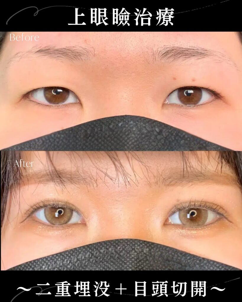 埋没法と目頭切開の症例写真 (2)