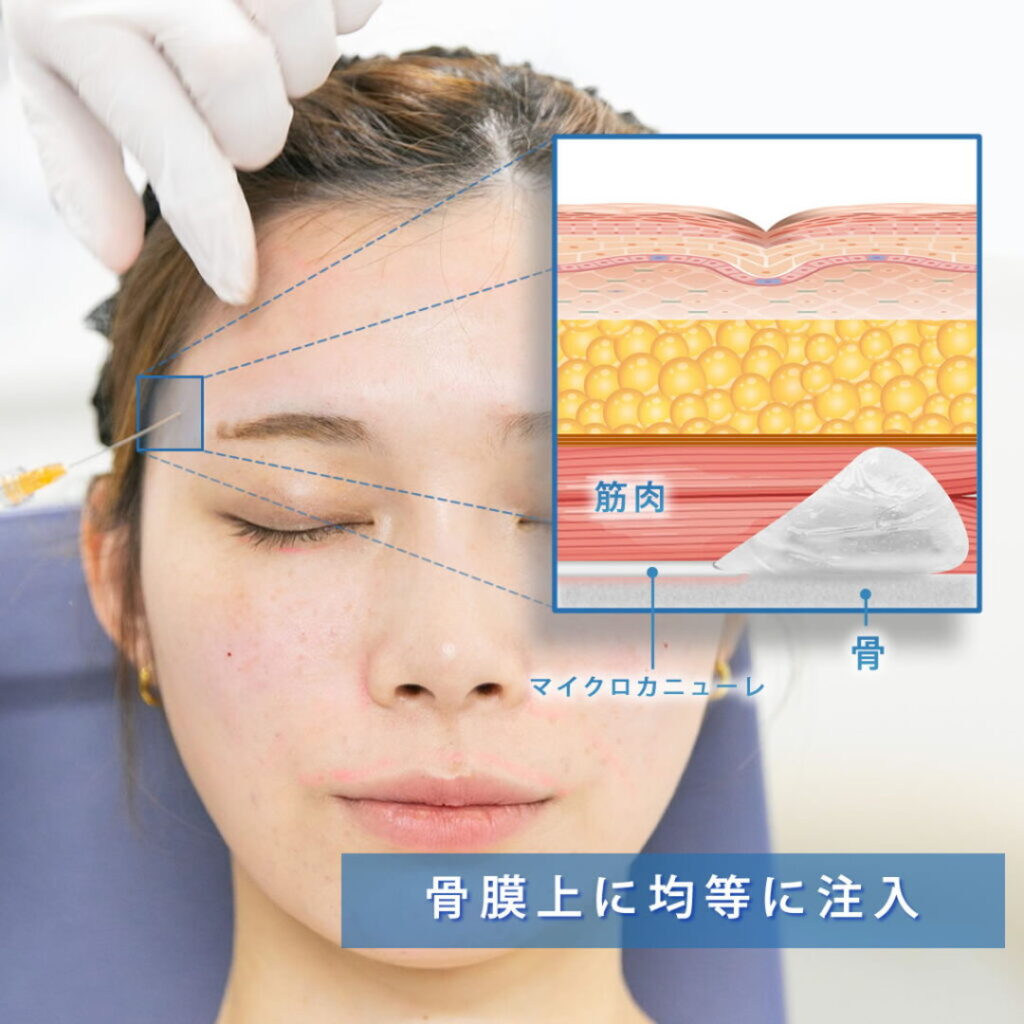 額にヒアルロン酸を注入している図解