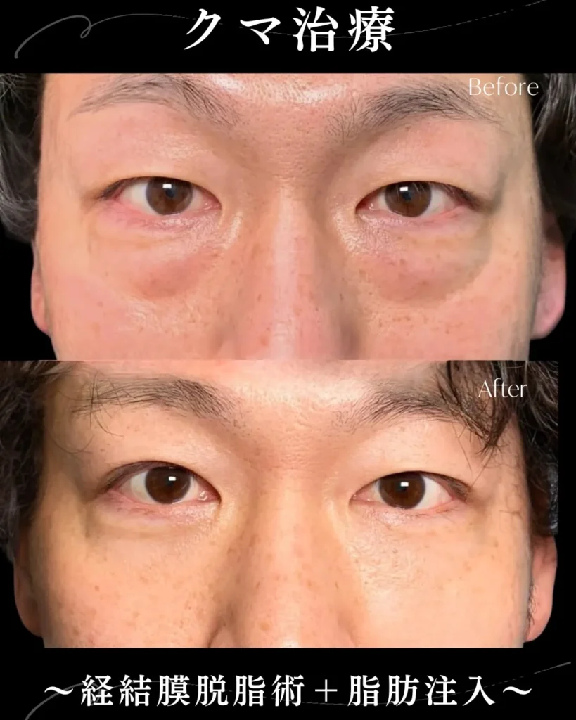 クマ取り_経結膜脱脂＋目の下脂肪封入（名医の岩井勝矢）