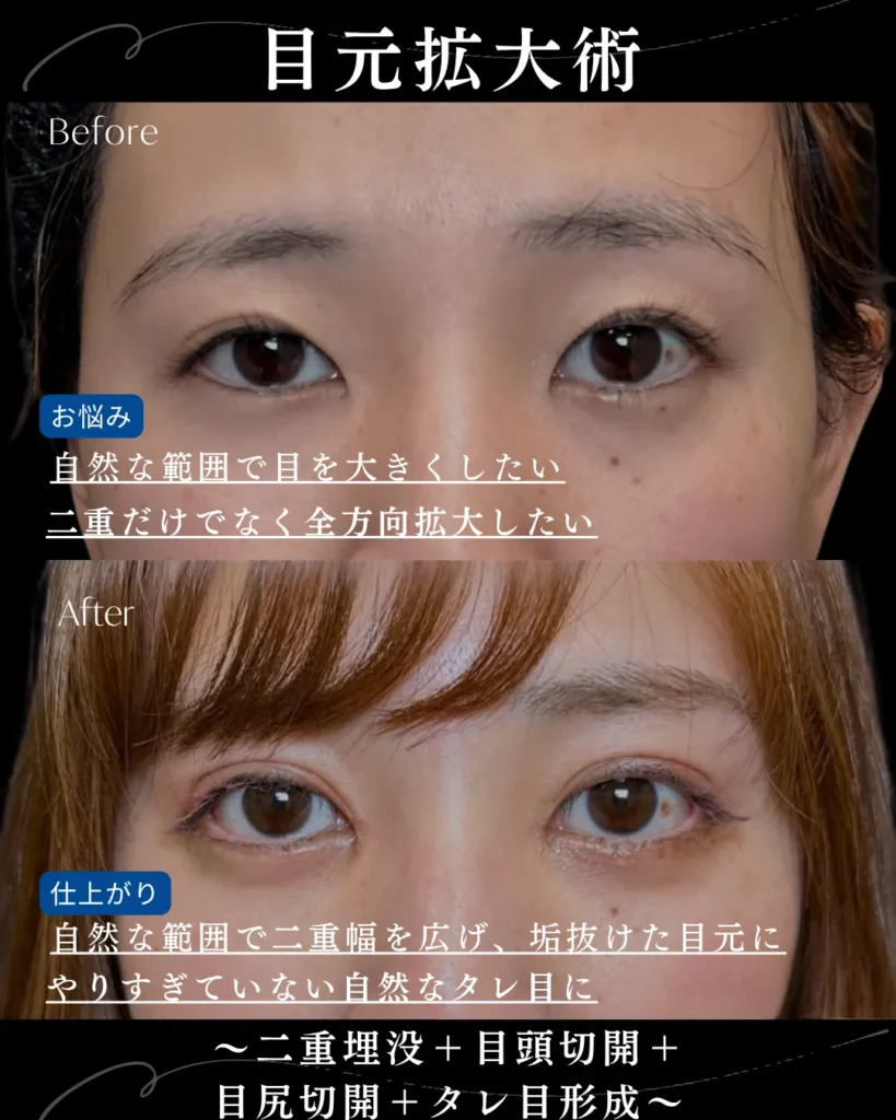 二重埋没法+目頭切開+目尻切開+タレ目形成(名医の岩井勝矢)