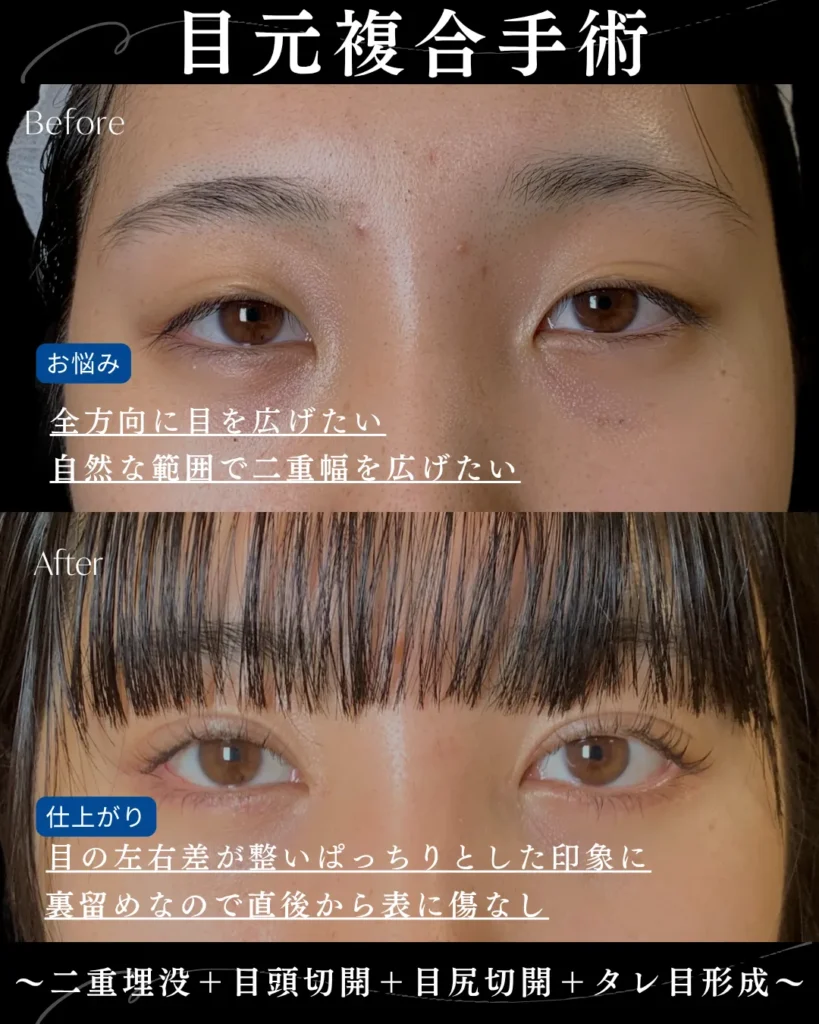 二重埋没法+目頭切開+目尻切開+タレ目形成(名医の岩井勝矢)