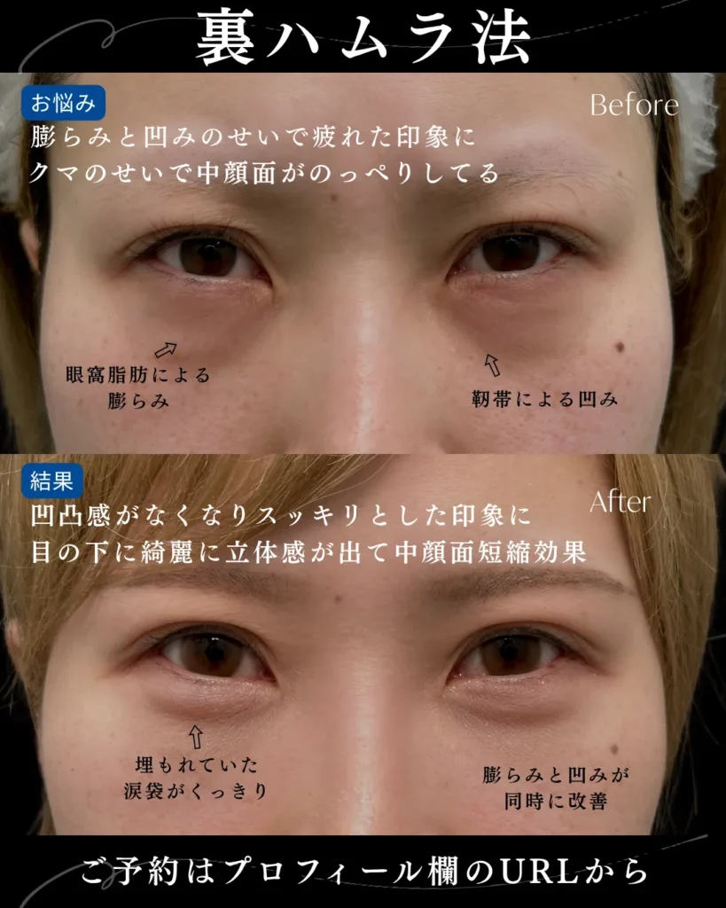 クマ取り_裏ハムラ法(名医の岩井勝矢)