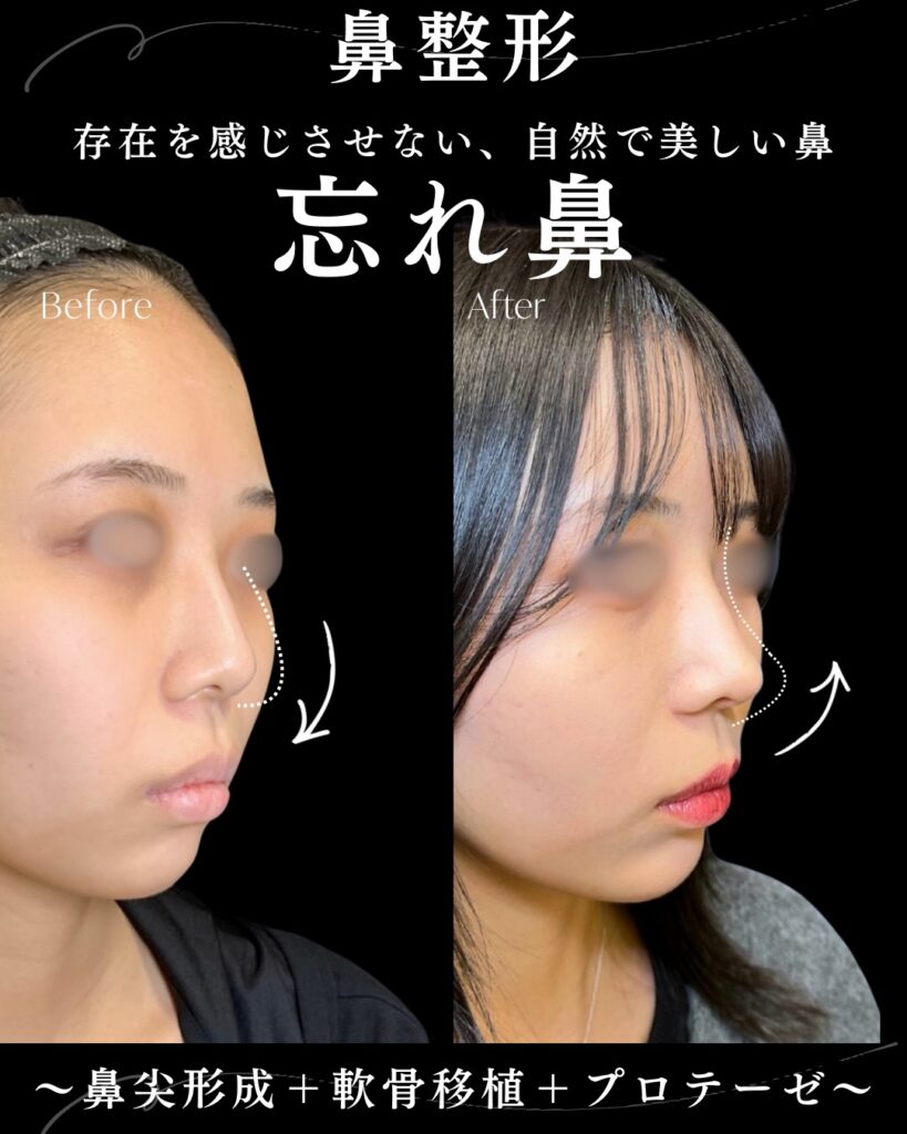 鼻尖形成と軟骨移植とプロテーゼの症例写真 (3)