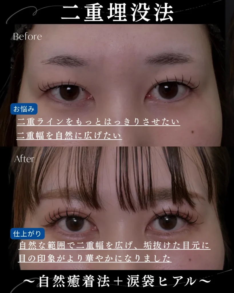 二重埋没法_自然癒着法+ヒアルロン酸18-2(涙袋)(名医の岩井勝矢)